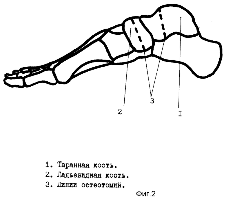 Строение пяточной кости. Таранная кость стопы человека анатомия. Таранная кость строение. Таранчатая кость стопы. Стопа анатомия кости таранная кость.