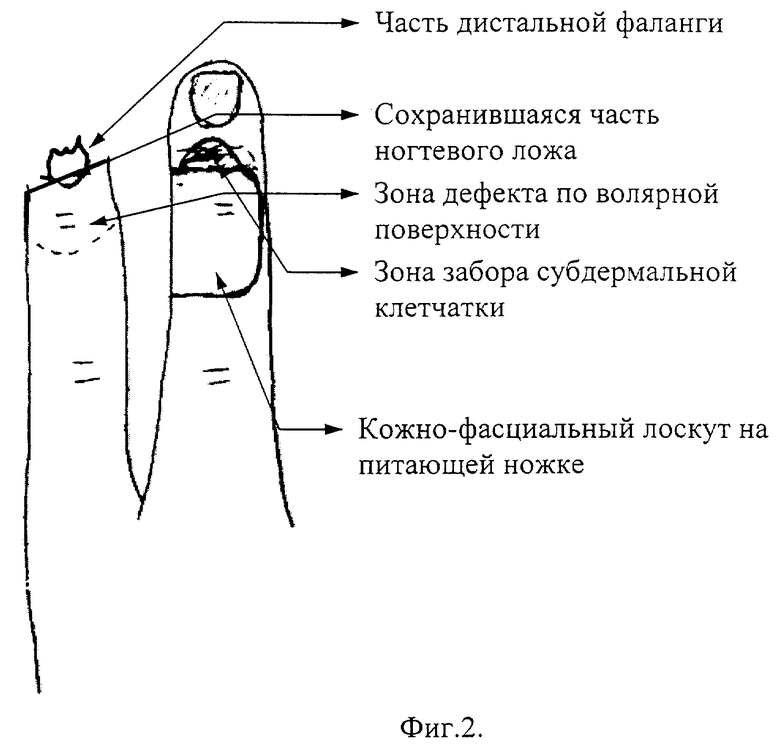 Карта вызова травматическая ампутация фаланги пальца