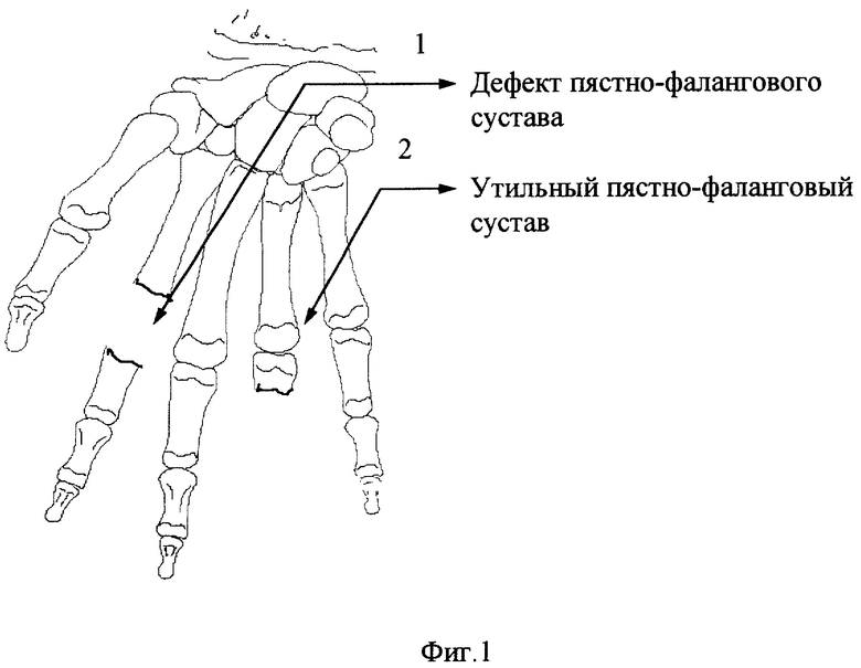 Пястно фаланговые суставы. Пястно фаланговый сустав 1 пальца кисти. Пястно фаланговый сустав форма. Строение пястно фалангового сустава.