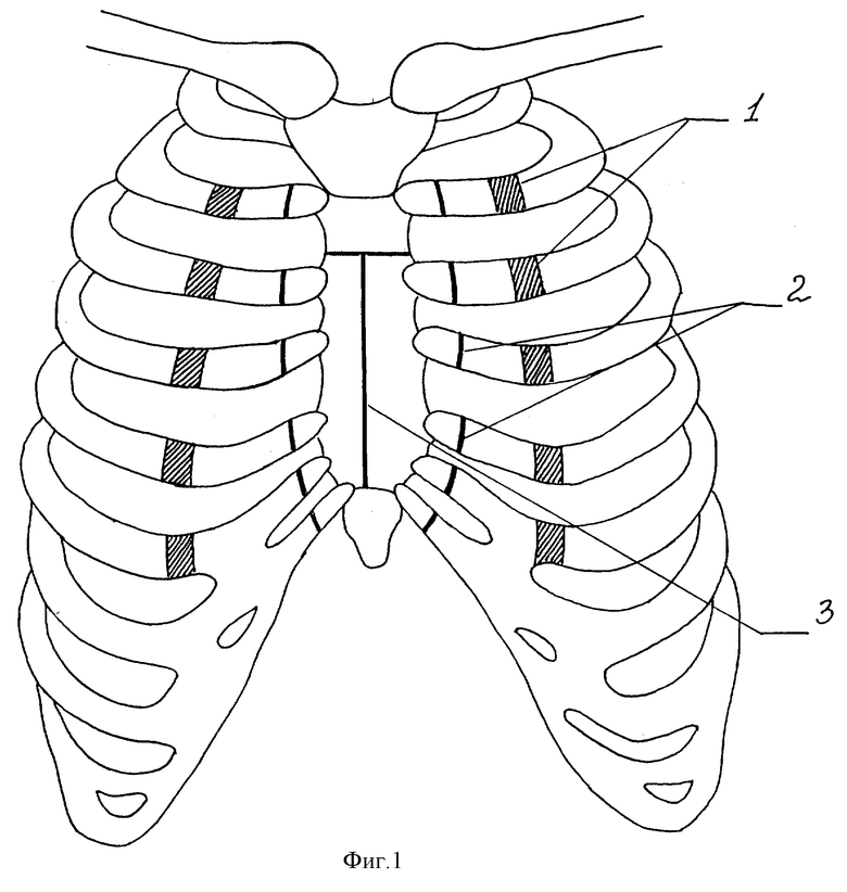 Грудная клетка схема