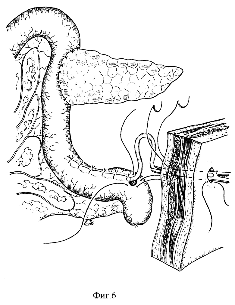 Панкреатодуоденальная резекция схема операции