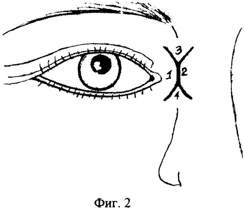 Eye corner. Тарзальный эпикантус. Эпикантус внутренний уголок глаза. Внутренний угол глаза.