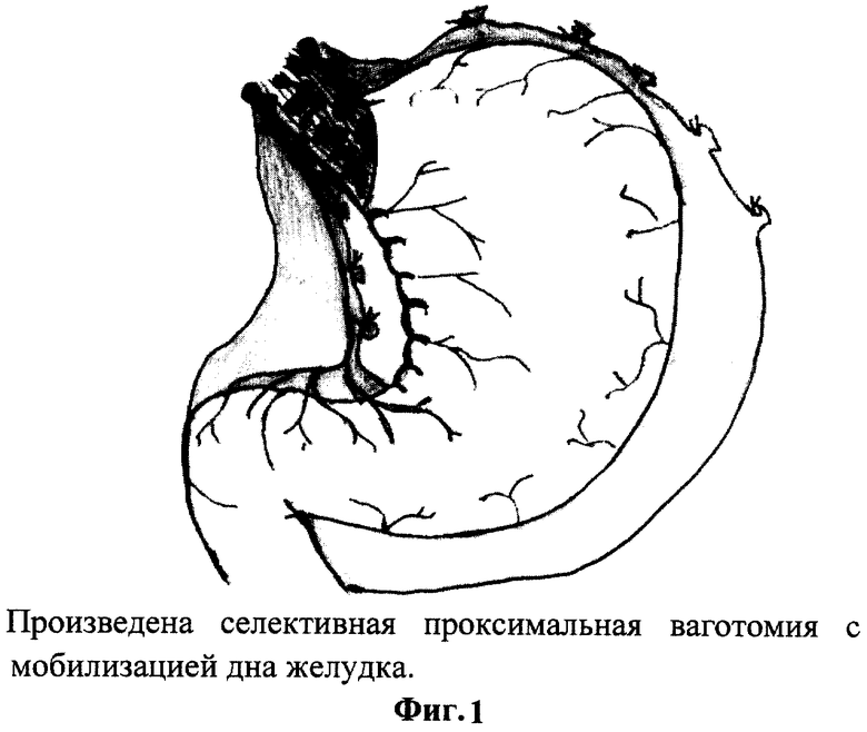 Вены желудка. Селективная проксимальная ваготомия показана. Проксимальная ваготомия. Показания для селективной проксимальной ваготомии.