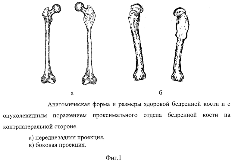 Проксимальный отдел кости. Проксимальный отдел бедренной кости. Уровни переломов проксимального отдела бедренной кости. Дистальный отдел левой бедренной кости. Бедренная кость классификация кости.