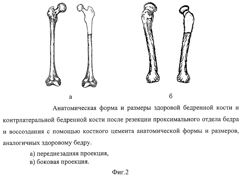 Проксимальный отдел бедренной кости. Дистальный эпифиз бедренной кости. Бедренная кость снизу. Проксимальные отделы конечностей. Проксимальный это в анатомии.