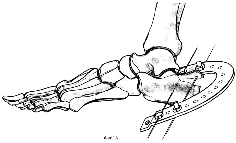 Пяточная кость после операции. Скелетное вытяжение пяточной кости. Перелом пяточной кости остеосинтез. Перелом пяточной кости репозиция. Перелом таранной кости остеосинтез.