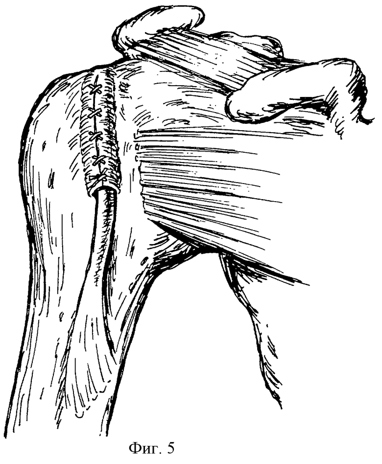 Привычный вывих плечевого сустава. Лавсанопластика капсулы плечевого сустава. Вывих плечевого сустава операция. Первичный вывих плечевого сустава операция. Вывих плеча операция Вайнштейна.
