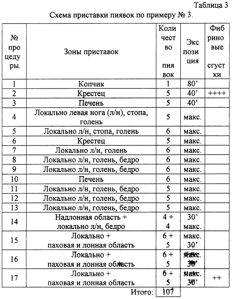 Пиявки при ангине схема