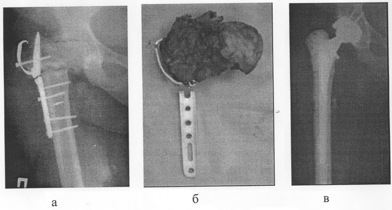 Ход после. Аллопластика тазобедренного сустава. Пластина в тазобедренном суставе. Пластина при переломе шейки бедра. Эндопротез подвздошной кости.