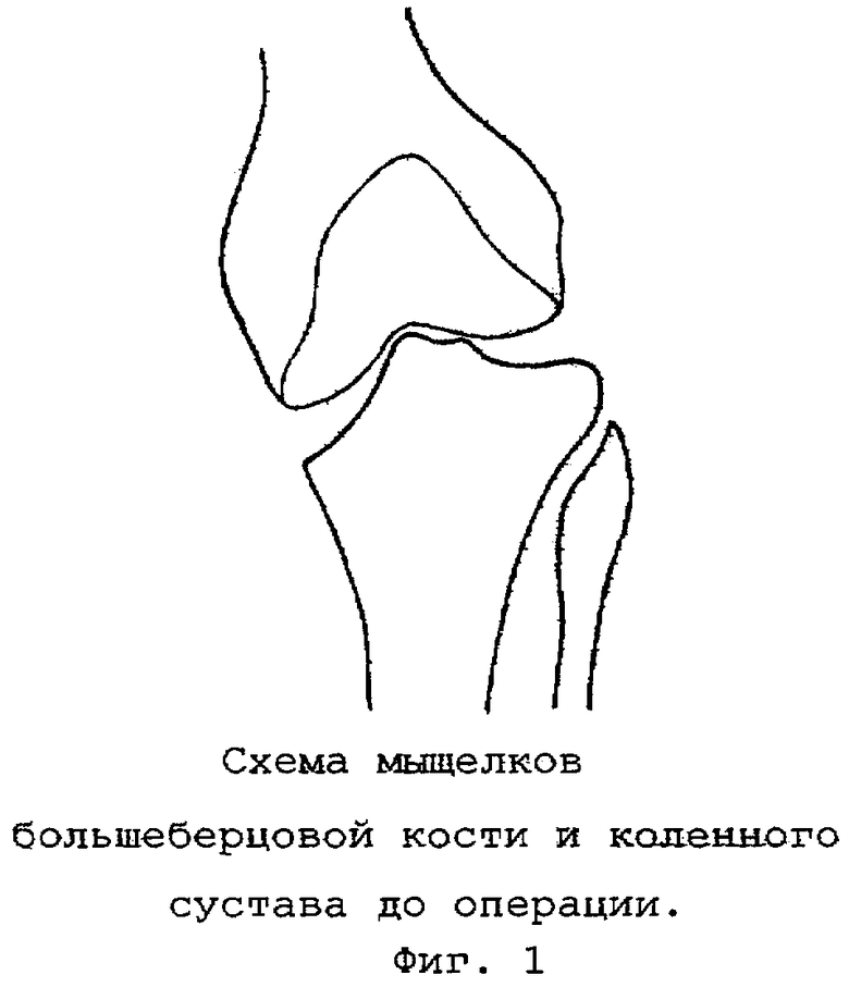 Мыщелок колена. Медиальный мыщелок большеберцовой кости перелом. Перелом наружного мыщелка большеберцовой кости рентген. Задний отдел латерального мыщелка большеберцовой кости. Задний отдел медиального мыщелка большеберцовой кости.