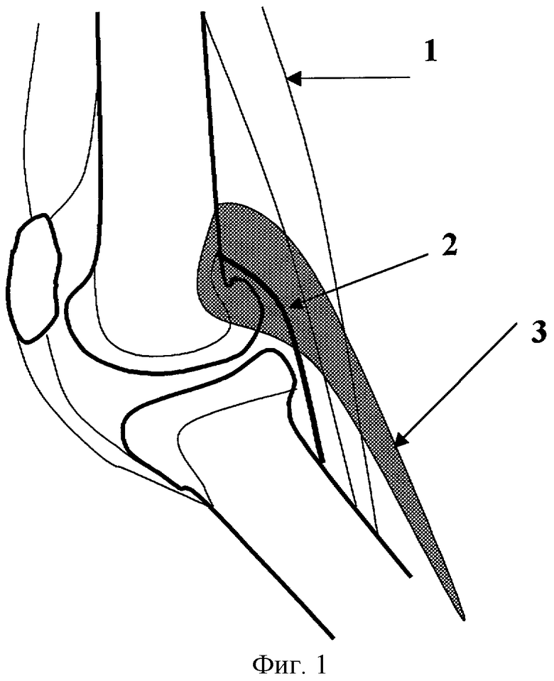 Сгибательная контрактура сустава. Сгибательная контрактура колена. Сгибательные контрактуры коленных суставов. Сгибательная зона коленного сустава.