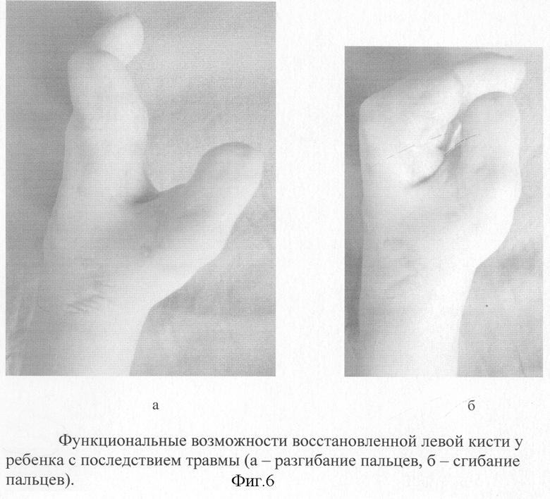 Ампутация кисти мкб 10. Ампутация пальцев кисти. Повреждения кисти у детей. Реконструкция пальцев кисти. Исправление деформации пальцев кисти.