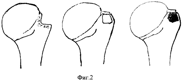 Импрессионный головки кости. Импрессионный перелом головки плечевой кости. Деформация головки плечевой кости. Импрессионная деформация головки плечевой кости. Перелом Хилла Сакса головки плечевой кости.