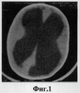 Реферат: Гидроцефалия