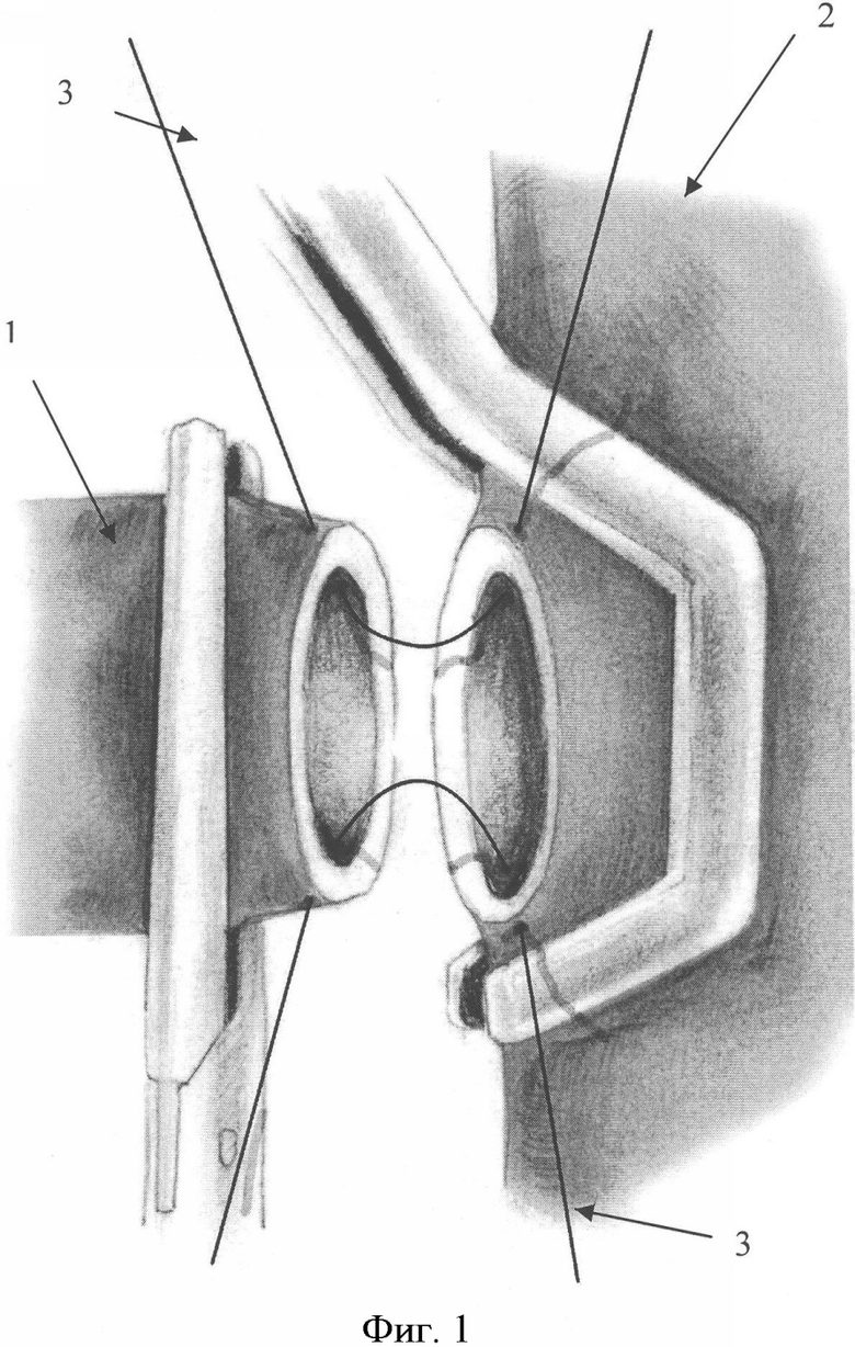 Бесшовное соединение сосудов метод а г коневского. Соединение сосудов.