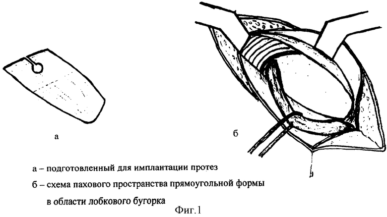 Пластика по лихтенштейну. Герниопластика по Лихтенштейну схема. Способы герниопластики при паховых грыжах. Пластика по Лихтенштейну схема. Пластика пахового канала по Лихтенштейну.