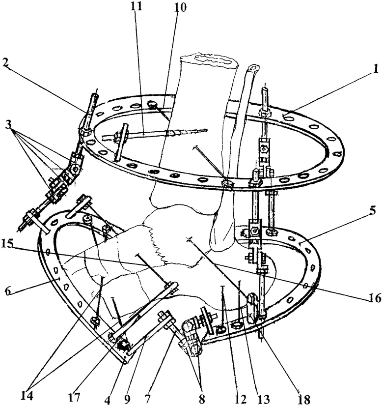 Компоновка аппарата. Перелом пяточной кости аппарат Илизарова. Аппарат Илизарова на пяточную кость. Остеосинтез чрескостный аппаратом внешней фиксации. Компрессионно-дистракционный остеосинтез таранной.