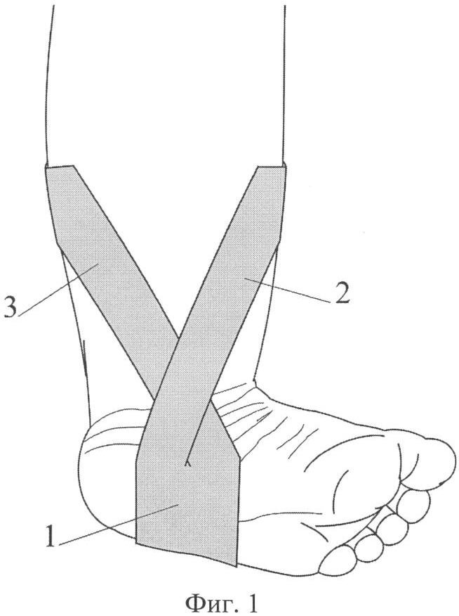 Тейпирование стопы при плоскостопии у взрослых схема