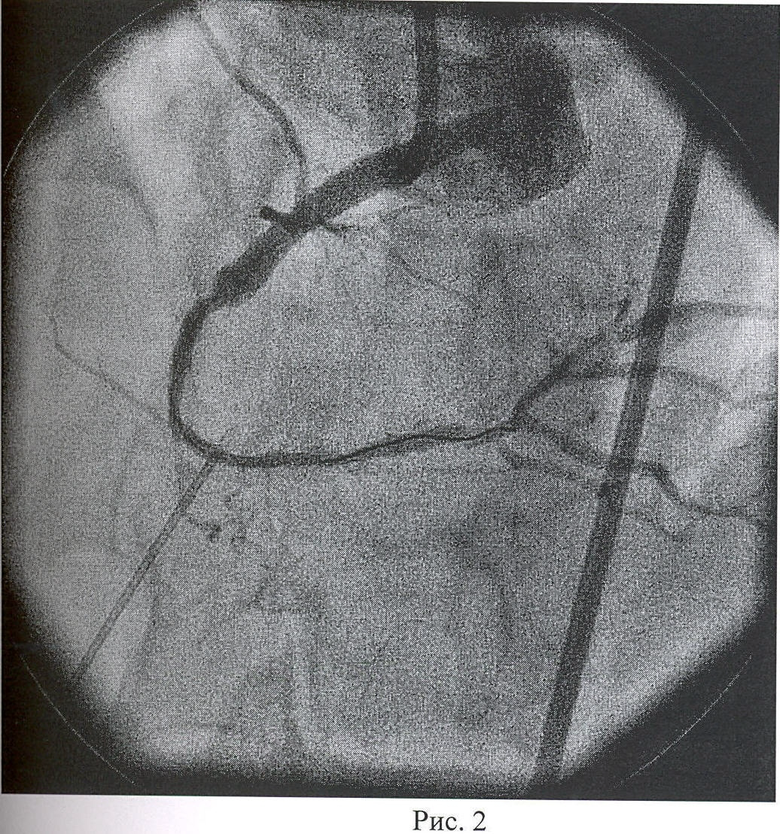 Коронарная окклюзия. Коронарография окклюзия. Окклюзия сосудов сердца.