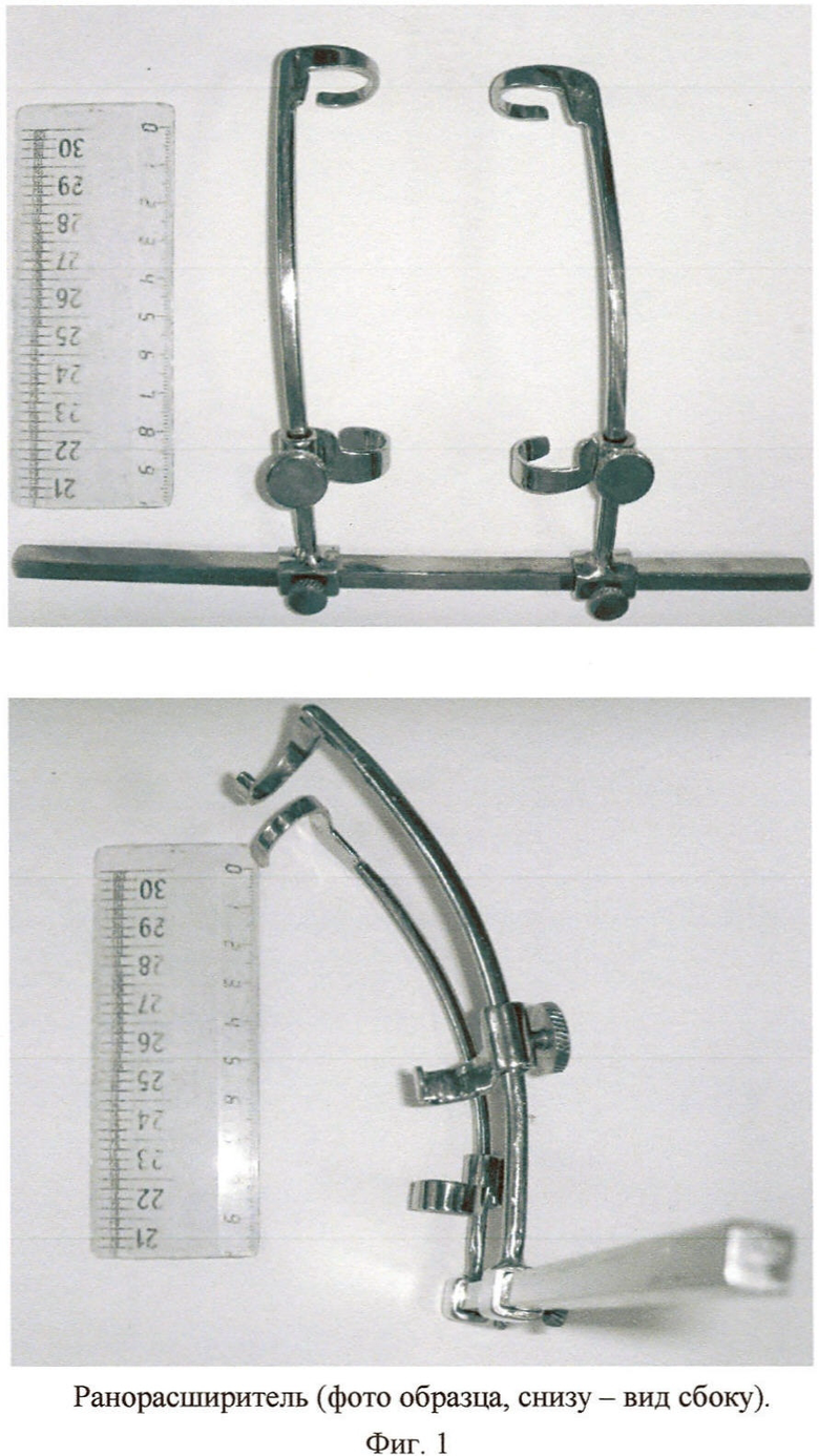 Ранорасширитель труссо фото