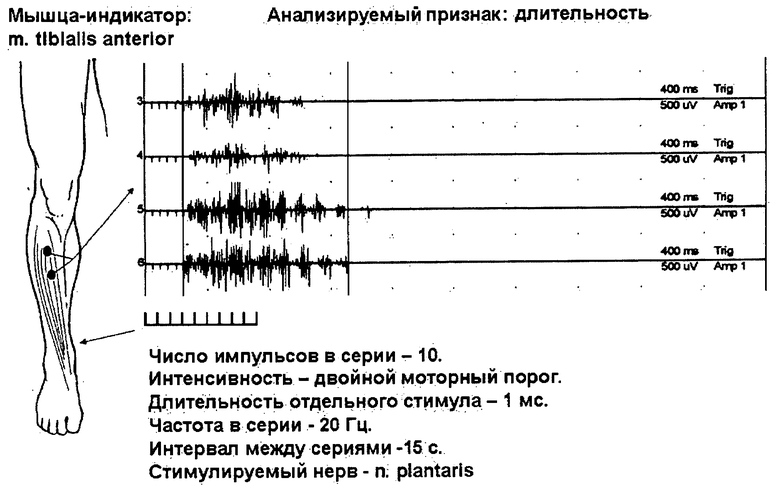 Эмг самара. ЭМГ мышц. Электромиография. ЭМГ сигнал. Электромиография при параличе.