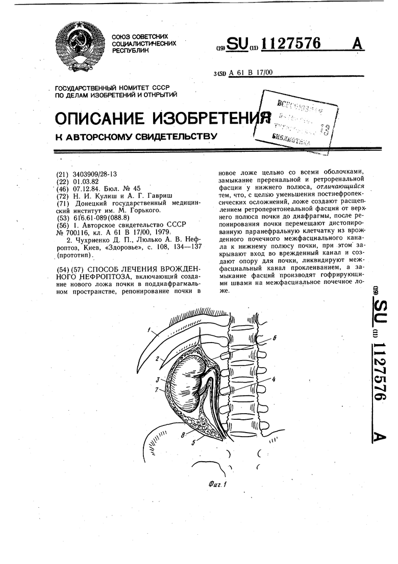 Нефроптоз почки отзывы