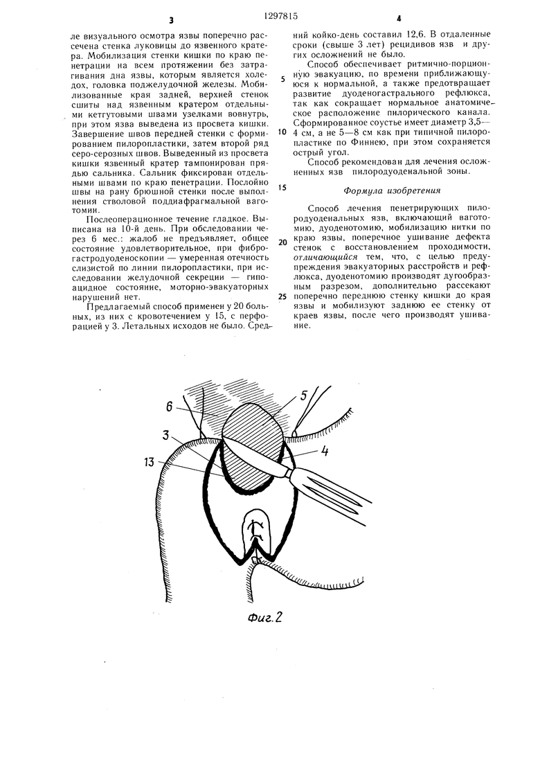 Способ лечения пенетрирующих пилородуоденальных язв. Советский патент 1987  года SU 1297815 A1. Изобретение по МКП A61B17/00 A61B17/11 .