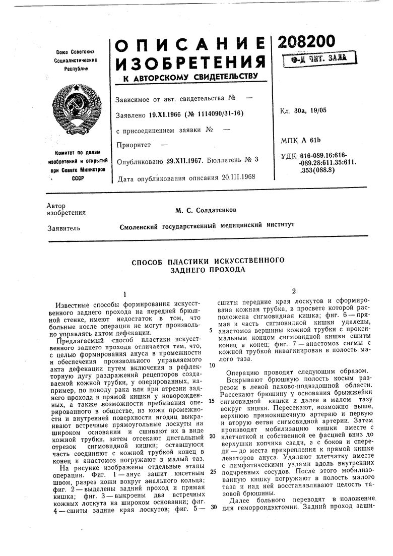 СПОСОБ ПЛАСТИКИ ИСКУССТВЕННОГО ЗАДНЕГО ПРОХОДА. Советский патент 1968 года  SU 208200 A1. Изобретение по МКП A61B17/00 A61B17/11 .